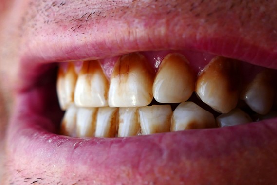 What causes stained teeth