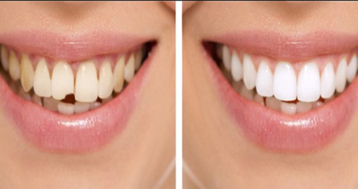 Teeth Restoration