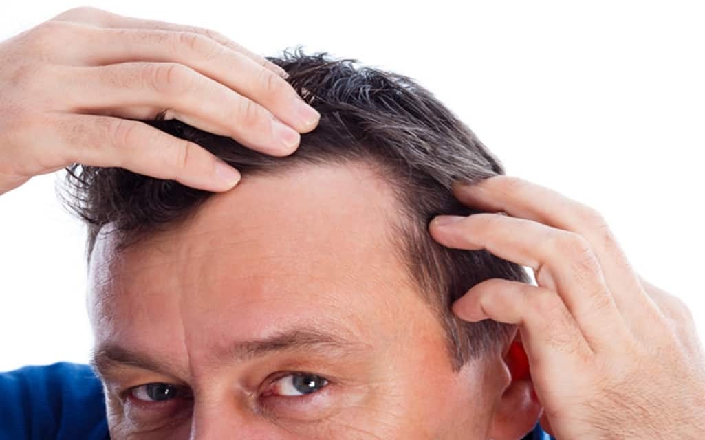 Therapy for Hair Loss