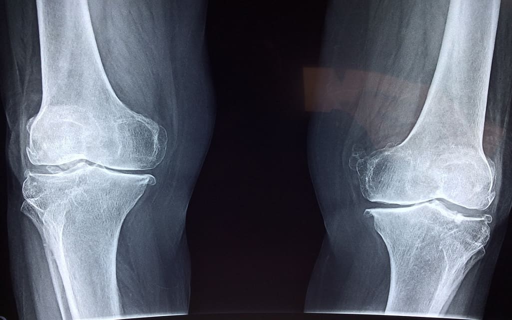 joint replacement surgeries