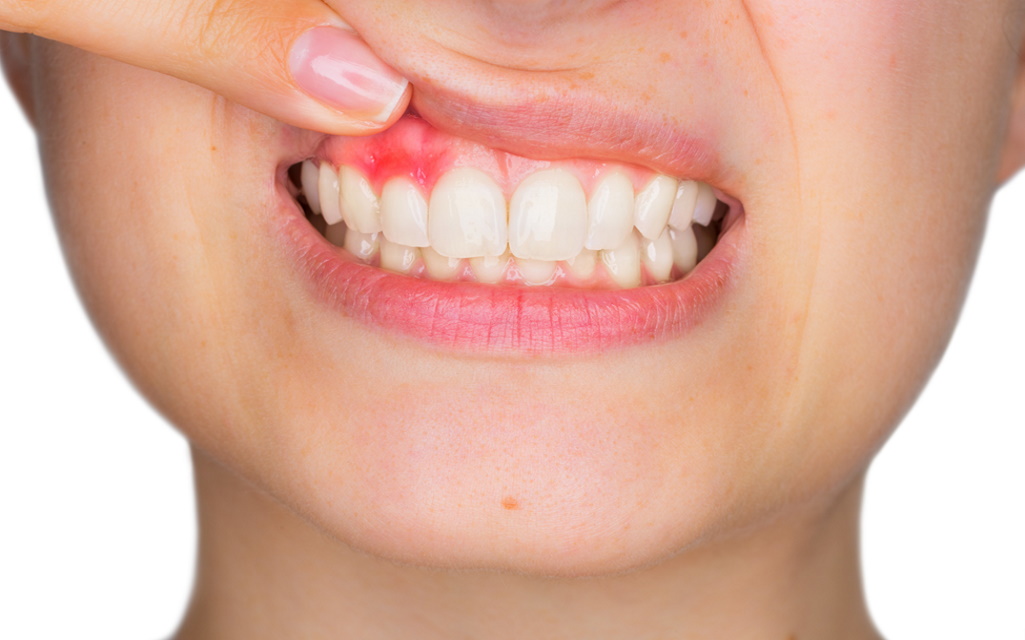 Signs of Severe Gum Disease