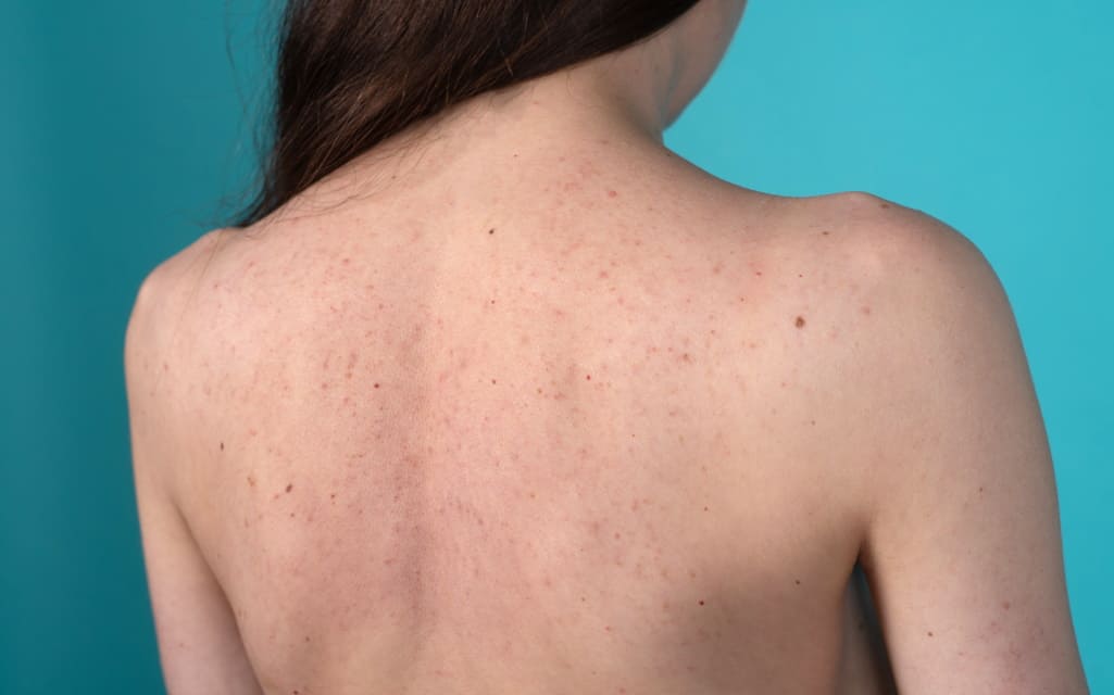 Types of Dark Spots and How to Treat Them At Home